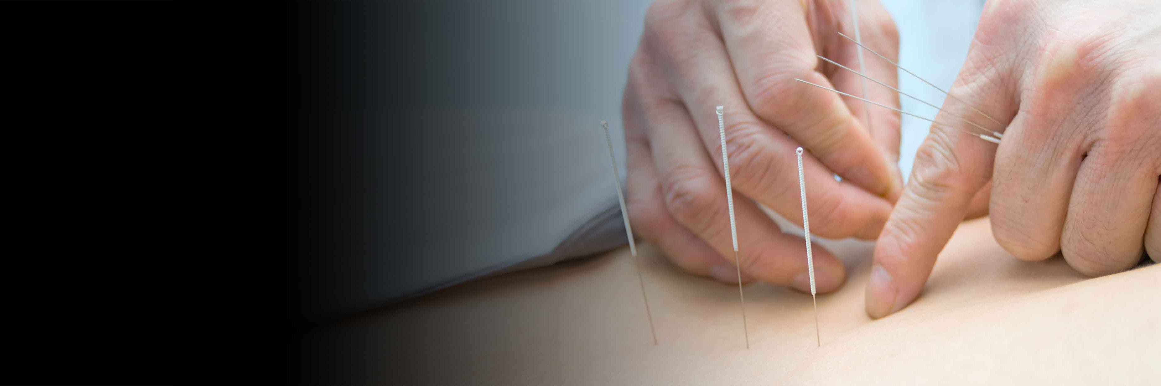 Quick, Affordable Acupuncture Therapy in Denver YAO Clinic